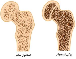 علائم پوکی استخوان در زنان و مردان