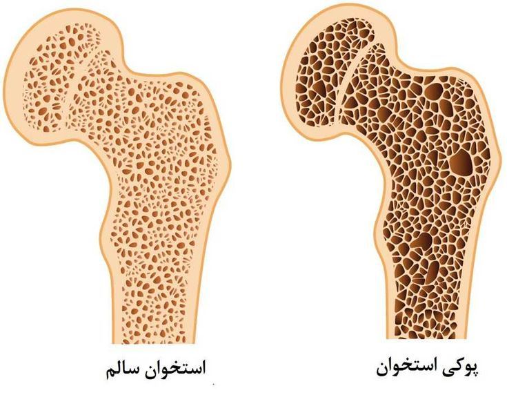 علائم پوکی استخوان در زنان و مردان